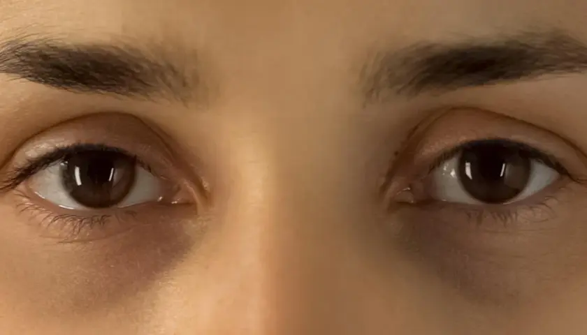 Augenringe mangel an Schlaf. Dunkle Schatten unter den Augen deuten auf Müdigkeit hin.