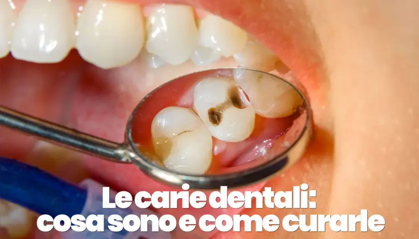 Denti con evidenti carie visibili nello specchietto del dentista.
