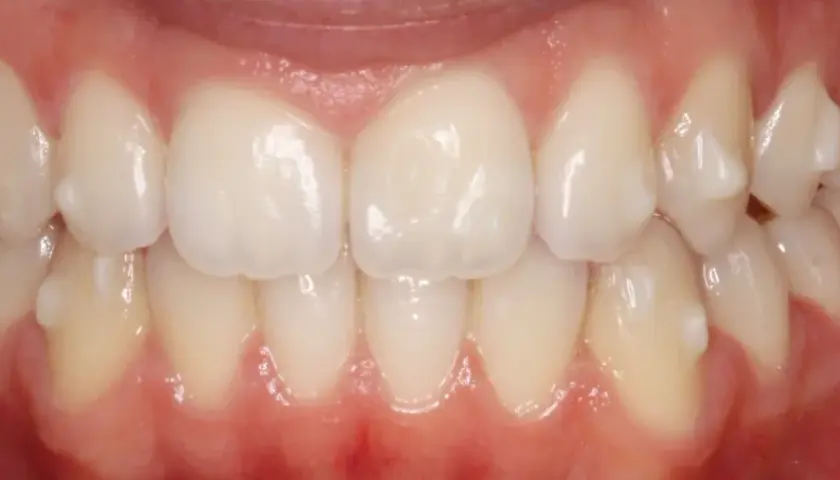 Dientes alineados y sanos, resultado de un tratamiento de ortodoncia invisible, **invisalign sin ataches**.
