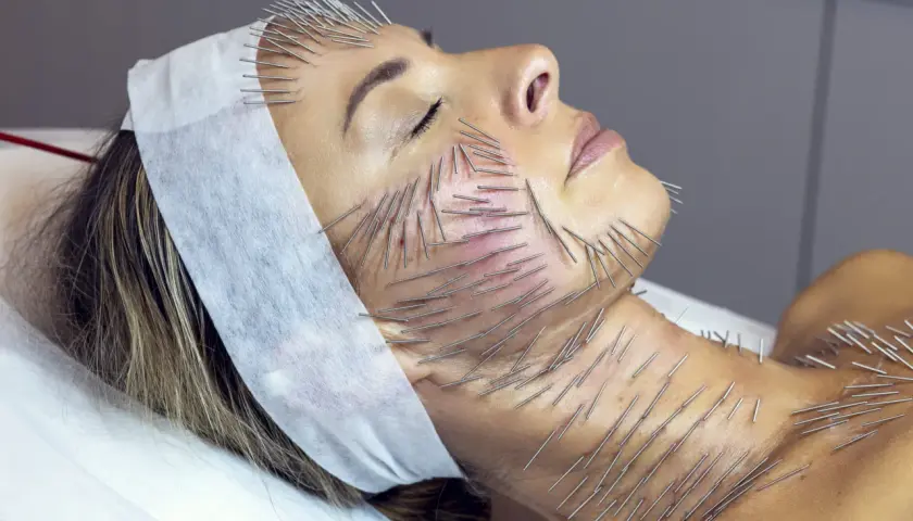 Kobieta poddana zabiegowi akupunktury twarzy i szyi. Liczne igły wbijane są w skórę, co jest częścią terapii needle shaping.