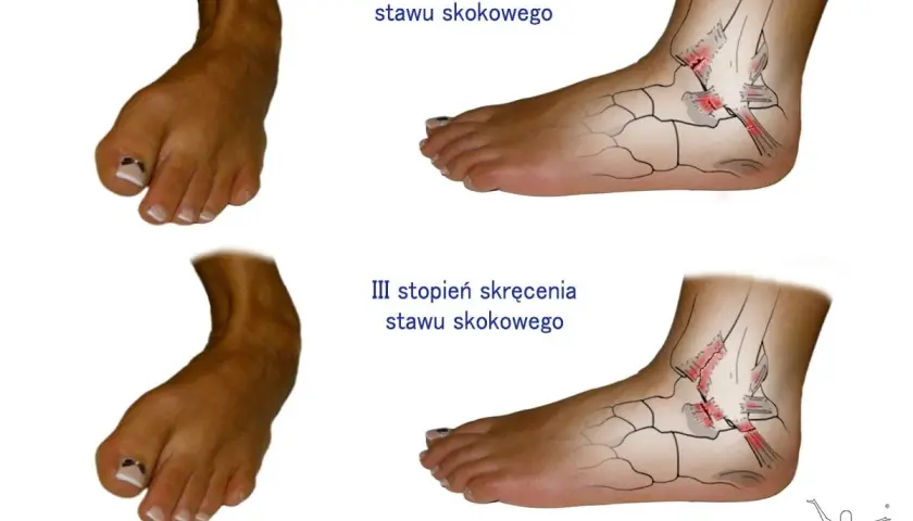 Stopnie skręcenia stawu skokowego: II stopień (leczenie trwa ok. 2-6 tyg.), III stopień (leczenie trwa ok. 6-12 tyg.).