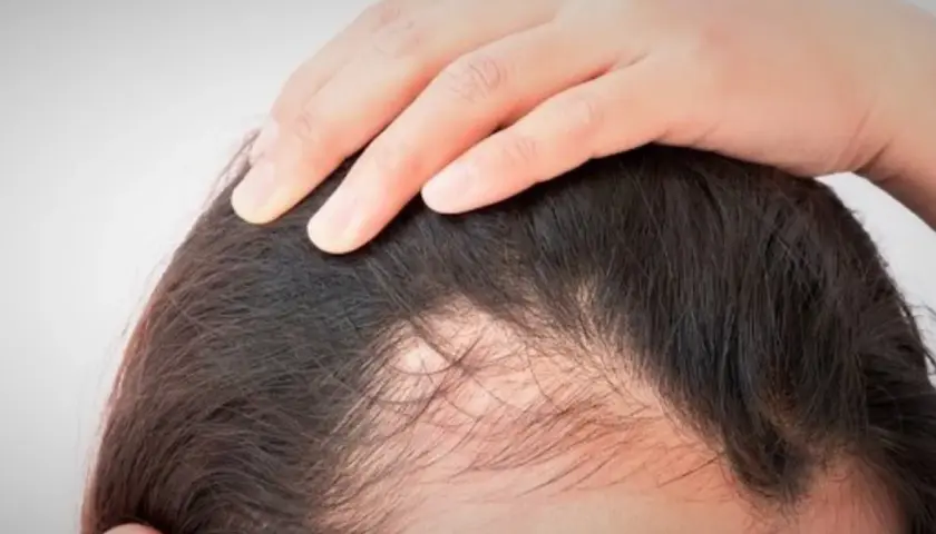 Mano tocando el cuero cabelludo con zonas de cabello escaso. ¿Qué vitamina me falta si se me cae el pelo?