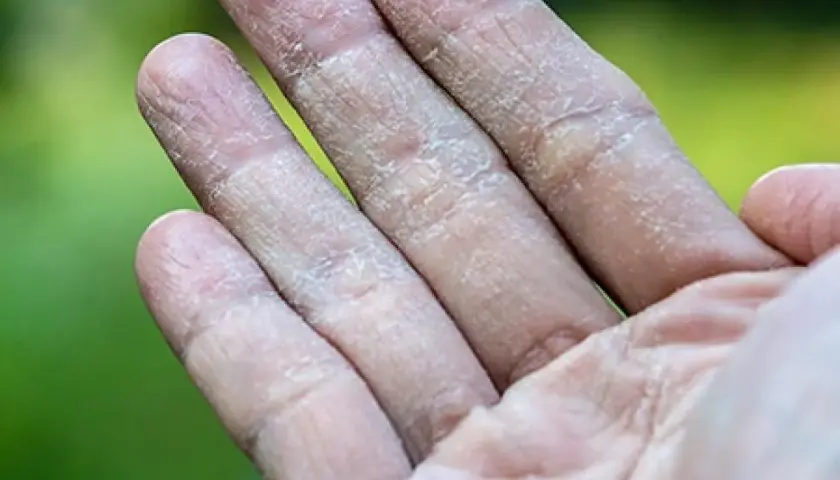 Dedos con piel seca y agrietada, síntoma de dishidrosis.