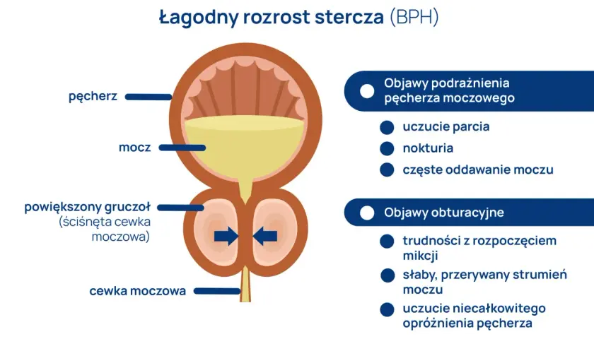 Ilustracja przedstawia łagodny rozrost stercza (BPH), gdzie powiększony gruczoł uciska cewkę moczową, powodując objawy podrażnienia i obturacji pęcherza.