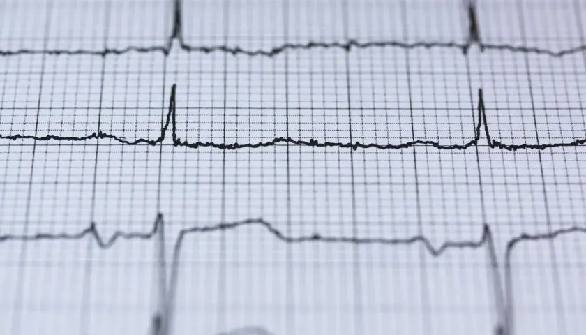 EKG z migotaniem przedsionków. Czy to powód do obaw przed wyrwaniem zęba? Analiza rytmu serca.