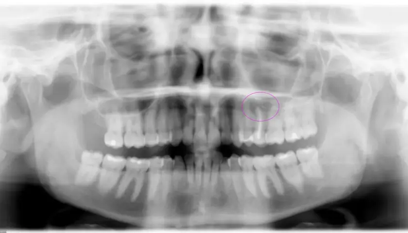 Radiografía panorámica dental que muestra la necesidad de una exodoncia quirúrgica de un diente superior, resaltado en círculo.