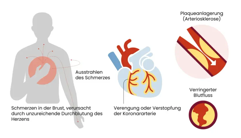 Brustschmerzen, die in Arme ausstrahlen, sind ein Symptom von Angina Pectoris, verursacht durch verengte Koronararterien und verringerten Blutfluss zum Herzen.