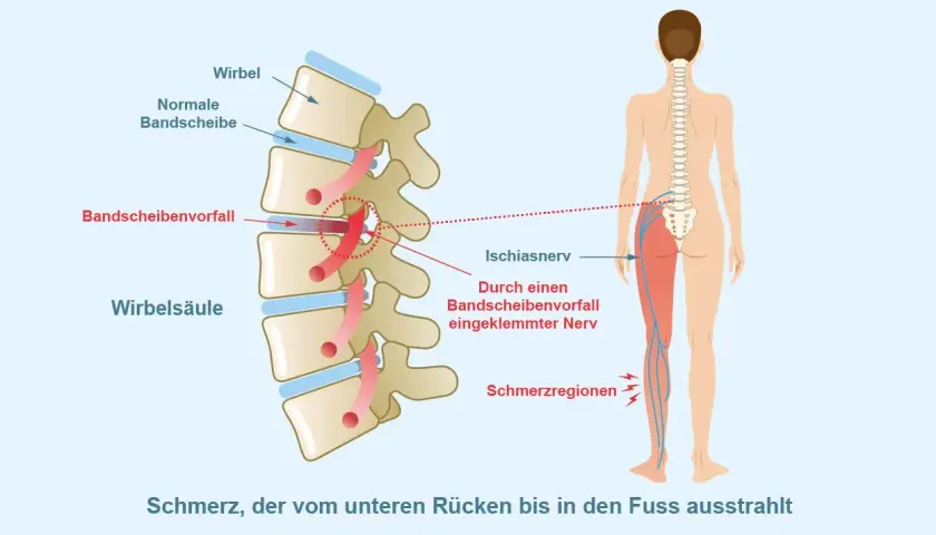 Bandscheibenvorfall klemmt Ischiasnerv ein, verursacht Schmerz vom Rücken bis zum Fuß. Was hilft sofort bei Ischias?