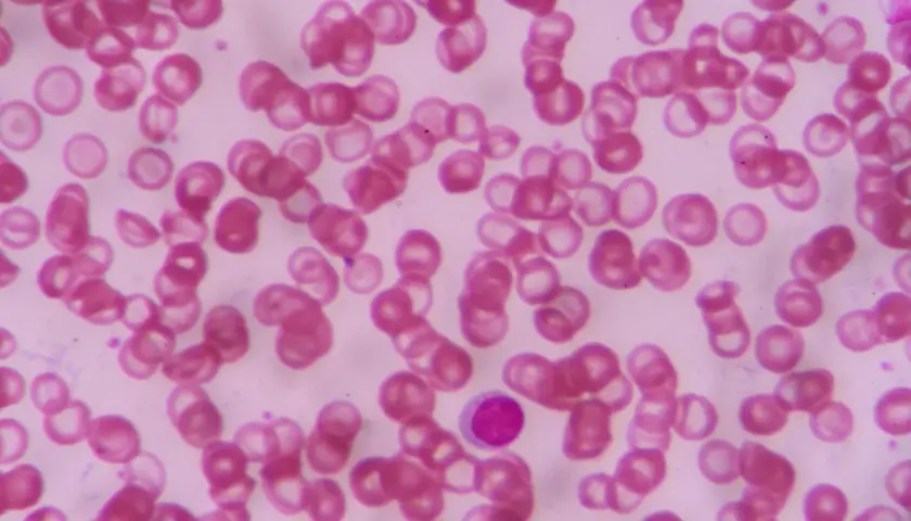 Widoczne liczne czerwone krwinki o zróżnicowanych kształtach i rozmiarach, co wskazuje na anizocytozę erytrocytów. W centrum obrazu pojedynczy, fioletowy leukocyt.