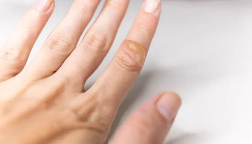 Gros plan sur une cloque de brûlure sur un doigt, suggérant des méthodes pour comment soigner une cloque de brûlure naturellement.