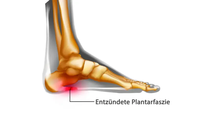 Entzündete Plantarfaszie im Fuß, die Schmerzen verursacht. Die Plantarfasziitis wird immer schlimmer.