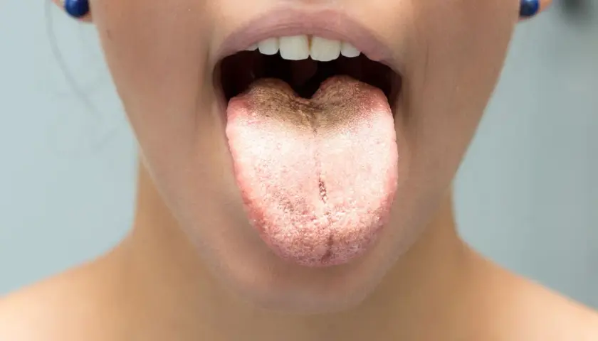 Lingua con patina biancastra, simile a un mughetto, che si estende sulla superficie.