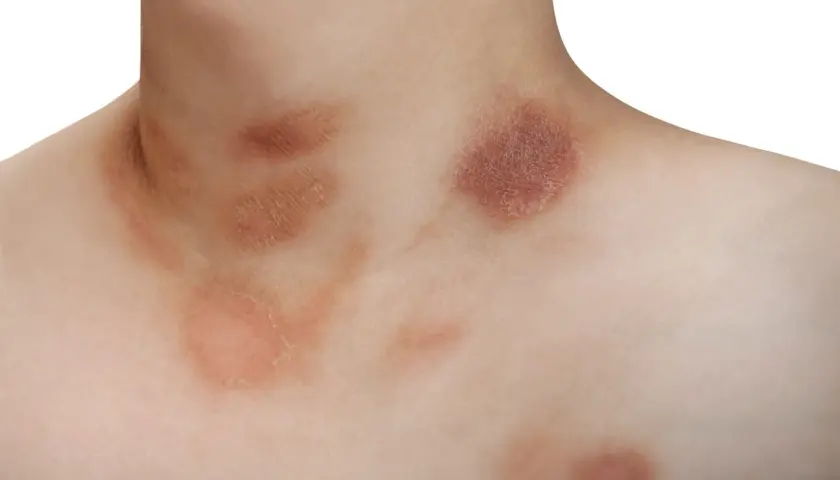 Macchie cutanee sul collo e petto, possibili manifestazioni di pitiriasi rosea di Gibert, a volte associate a stress.