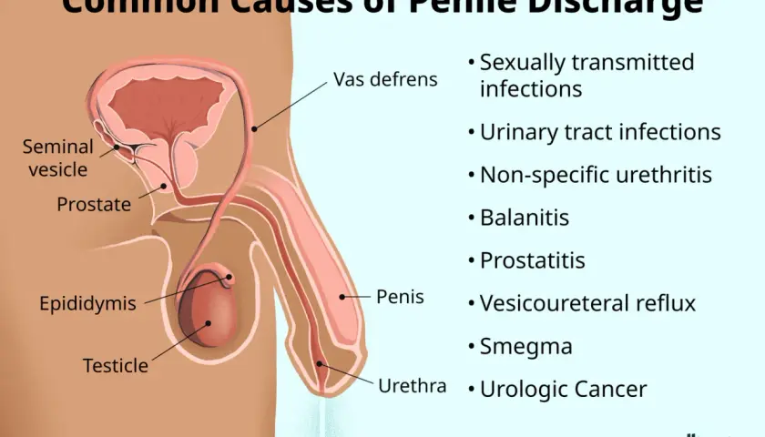 Diagrama anatómico del sistema reproductor masculino con etiquetas y lista de causas de secreción peniana.