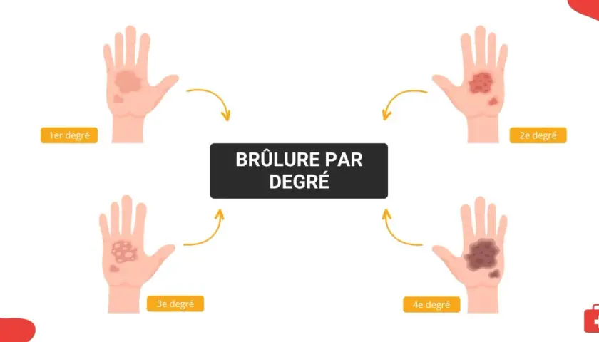 Illustration montrant l'évolution des brûlures de 1er degré à 4e degré sur une main. Le traitement d'une brûlure premier degré est le plus simple.