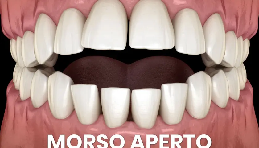 Denti bianchi e gengive rosa, con la scritta "MORSO APERTO". La lingua morsicata è visibile tra gli incisivi inferiori.