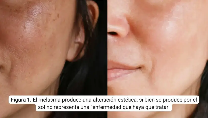 Comparación de piel con melasma y piel tratada. El ácido tranexámico para qué sirve: mejora manchas y unifica el tono.