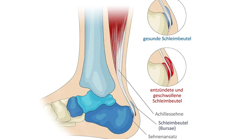 Die Achillessehne verbindet Wade und Ferse. Hier wird gezeigt, wo sich die Achillessehne und Schleimbeutel befinden, auch entzündete.