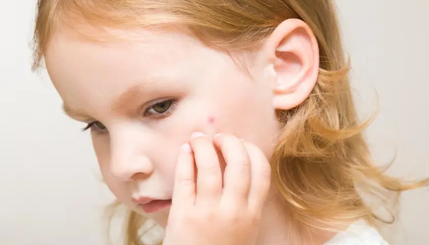 Un petit bouton rouge sur la joue d'une fillette aux cheveux blonds, peut-être un bouton de la 5ème maladie.