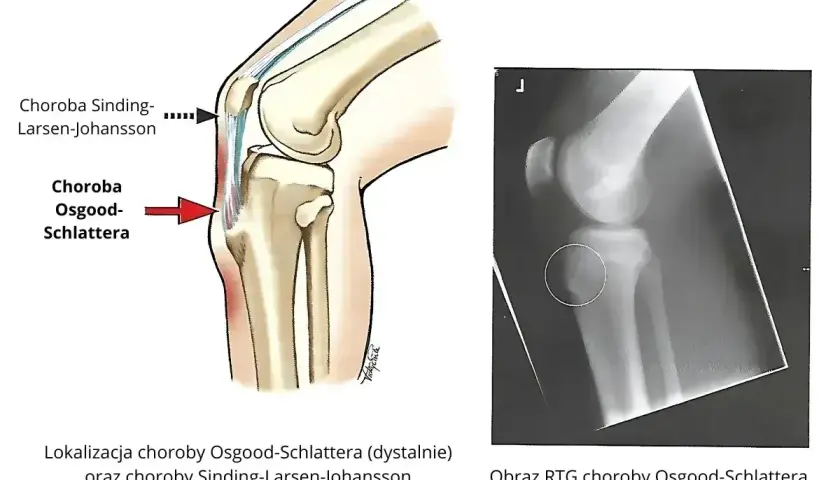 Ilustracja anatomiczna i RTG kolana pokazują lokalizację choroby Osgood-Schlattera.