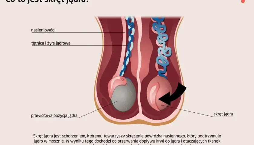 Ilustracja pokazuje prawidłową pozycję jądra i jego skręt. Skręt jądra to stan, gdy powrózek nasienny się skręca, blokując dopływ krwi.