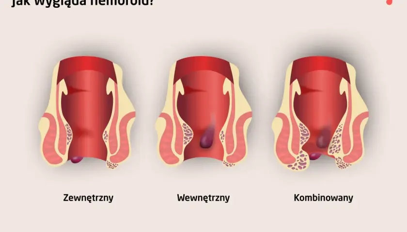 Ilustracja pokazuje zewnętrzne, wewnętrzne i kombinowane hemoroidy. Wczesne objawy raka odbytu mogą być mylone z hemoroidami.