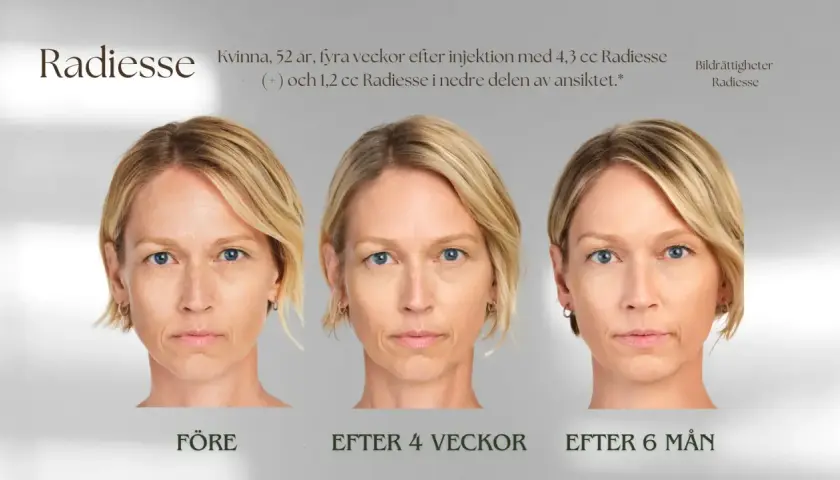Före- och efterbilder av en 52-årig kvinna som genomgått en Radiesse behandling för att förbättra ansiktets konturer.