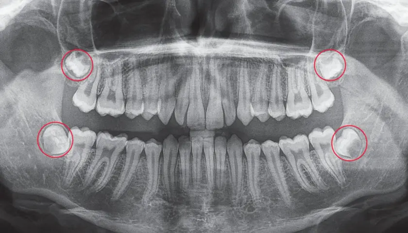 Radiografía panorámica dental. Se observan cuatro muelas del juicio impactadas, con posible hematoma tras extracción.
