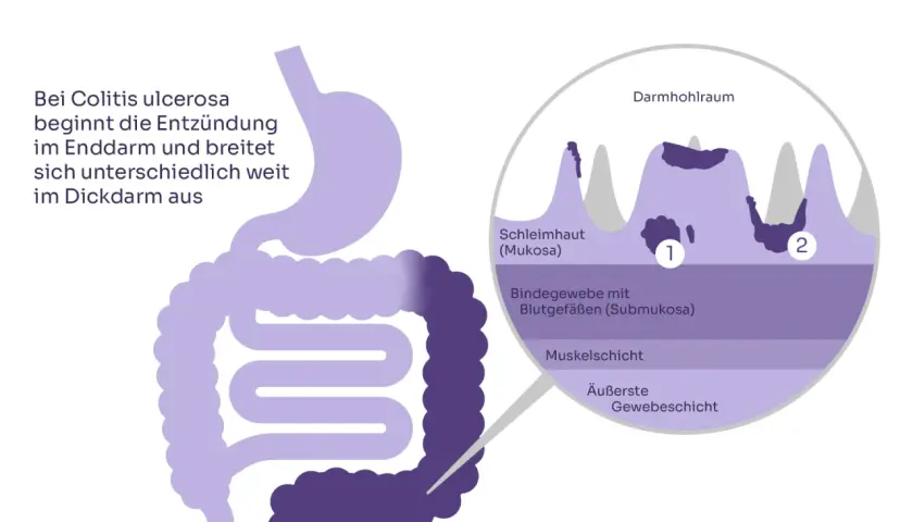 Colitis ulcerosa Symptome: Warnsignale, die Sie nicht ignorieren sollten