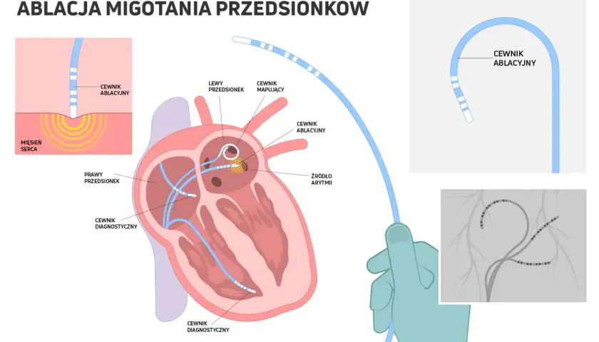 Ablacja migotania przedsionków: cewniki diagnostyczne i ablacyjne docierają do serca, by zlokalizować i zniszczyć źródło arytmii.