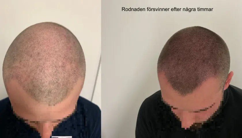 Före och efter bild på en hårtransplantation. Rodnaden i hårbotten, som kan uppstå efter att man vill exfoliera hårbotten, försvinner efter några timmar.
