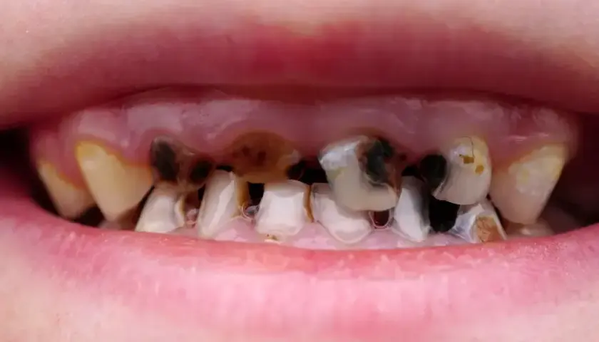 Jak wyleczyć próchnicę bez dentysty? Kiedy to możliwe?