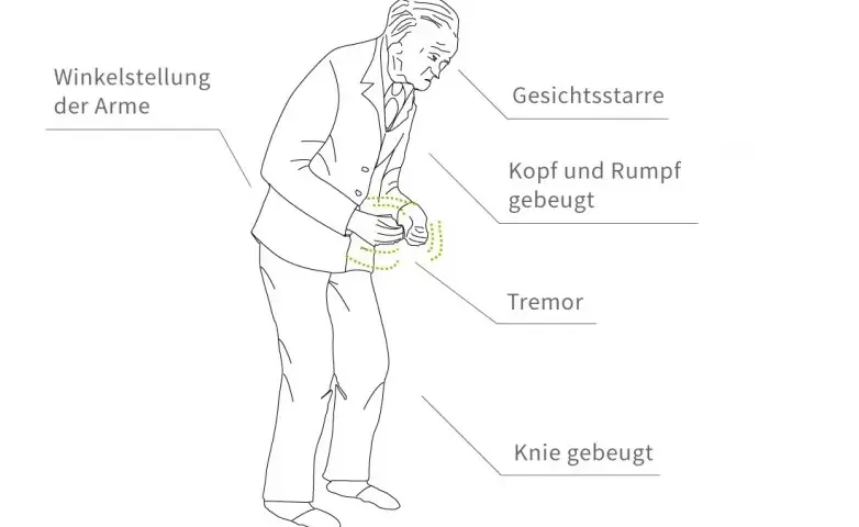 Diagnostik Parkinson Krankheit: So erkennen Sie die Symptome rechtzeitig