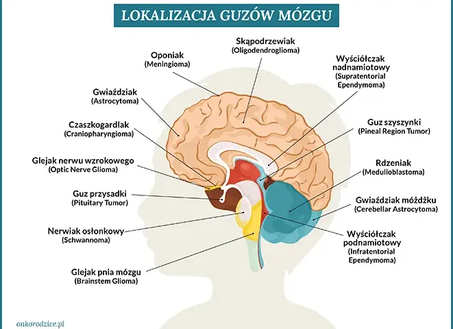 Czy to mogą być objawy guza mózgu? Zobacz, co powinieneś wiedzieć