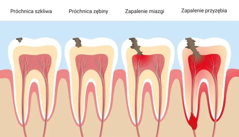 Ból zęba: czy to zapalenie miazgi? Rozpoznaj kluczowe objawy!