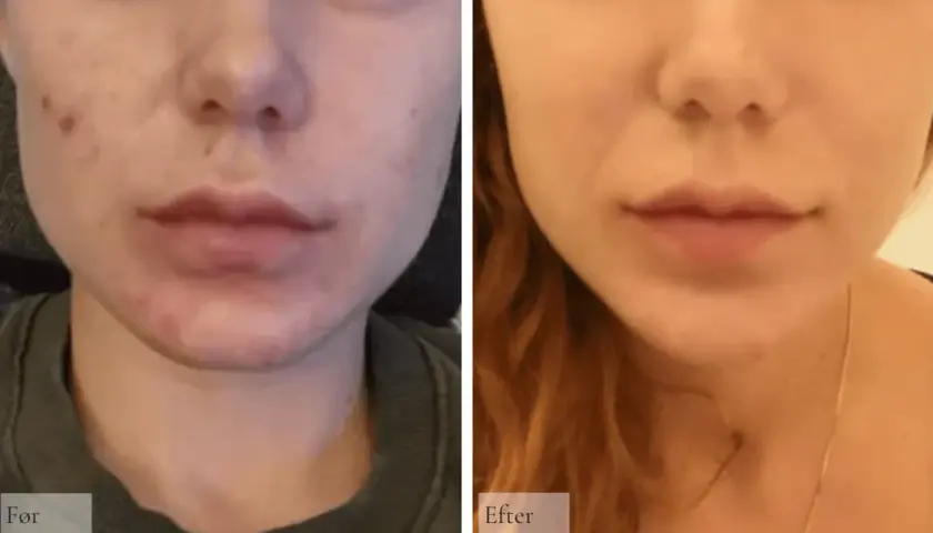 Före och efter bilder visar en hud med hyperpigmentering behandling. Huden är klarare och jämnare efter behandlingen.