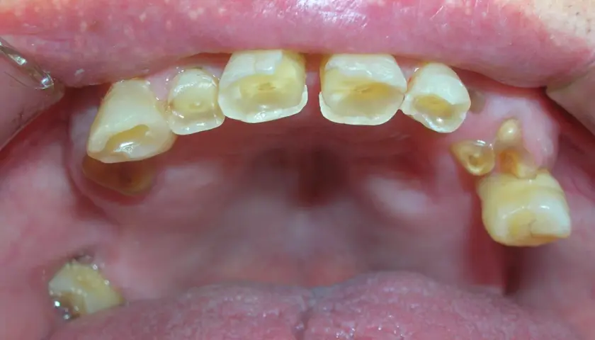 Boca con dientes desgastados y caries. Si los de abajo se mueven, los de arriba se caen.
