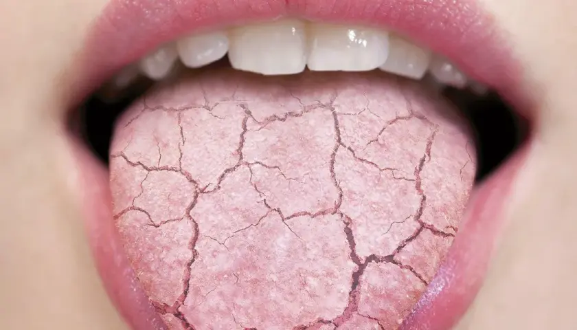 Lengua agrietada y seca, indicando posible boca ardorosa. Busca un tratamiento natural para aliviar la sequedad.