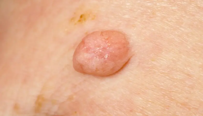 Zmiana skórna, która może być jednym z objawów HPV. Widoczny różowy, brodawkowaty narośl na skórze.