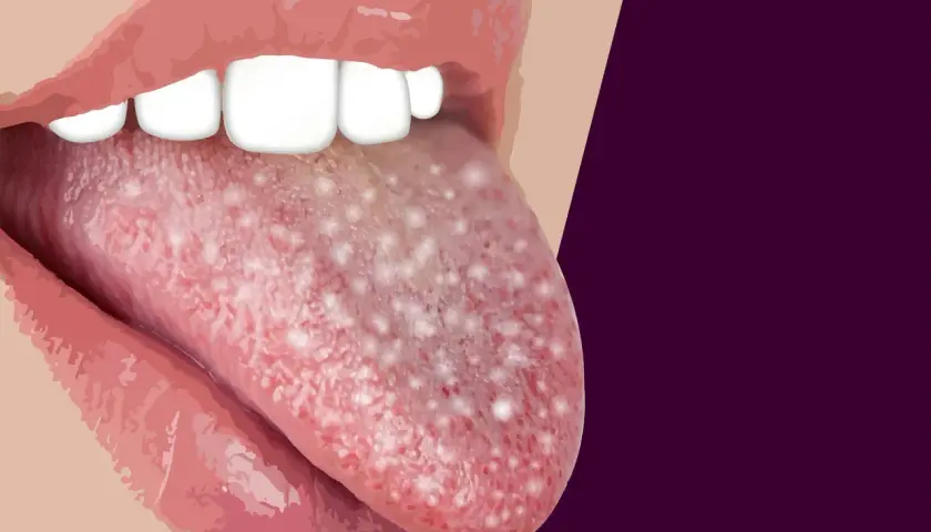 Lingua con puntini bianchi visibili, che potrebbero indicare una condizione medica.