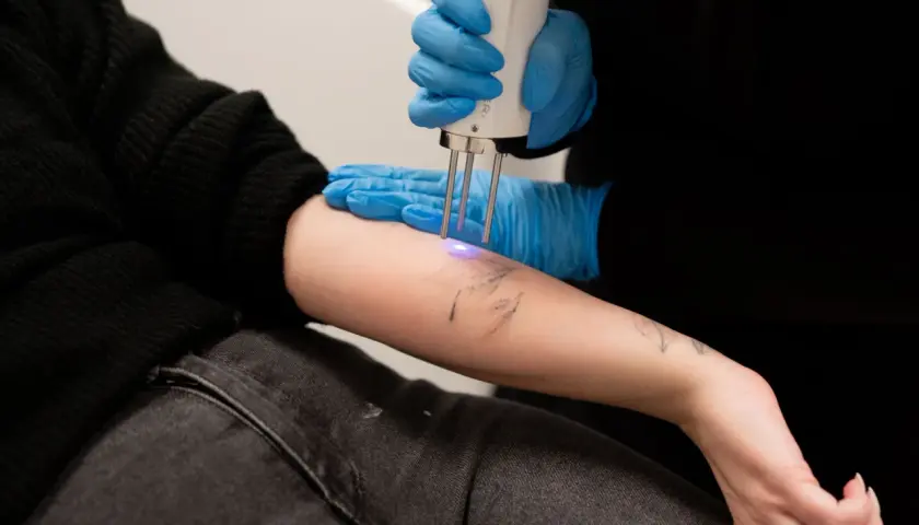 En person får en tatuering borttagen med laser. Undrar du över ta bort tatuering pris?