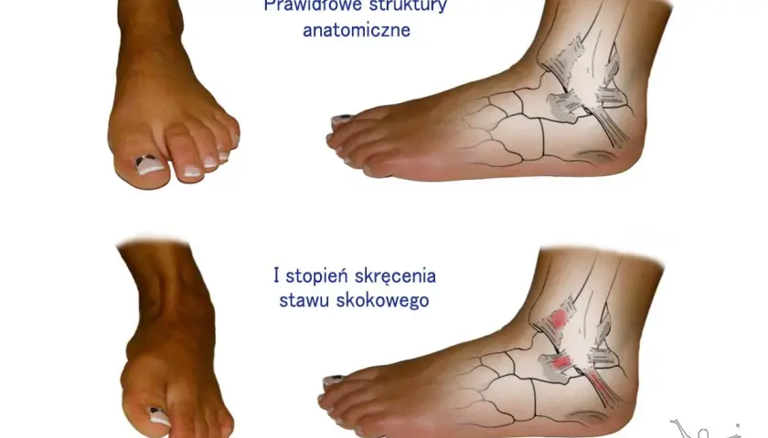 Po tym, jak krzywo stanąłem i boli mnie kostka, porównuję prawidłowe struktury anatomiczne stawu skokowego z I stopniem skręcenia.