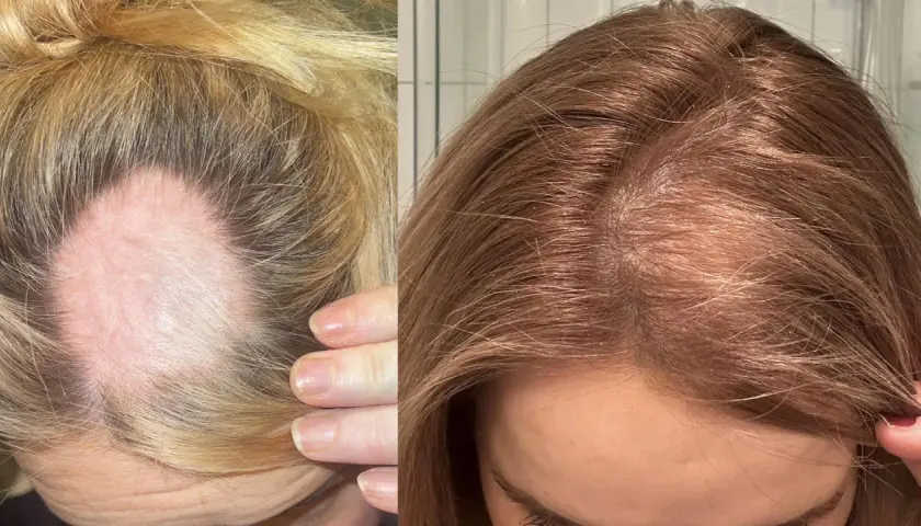 Före- och efterbilder som visar förbättring av androgent håravfall. Till vänster syns en kal fläck på en ljusblond hårbotten, till höger tätare, mörkare hår.