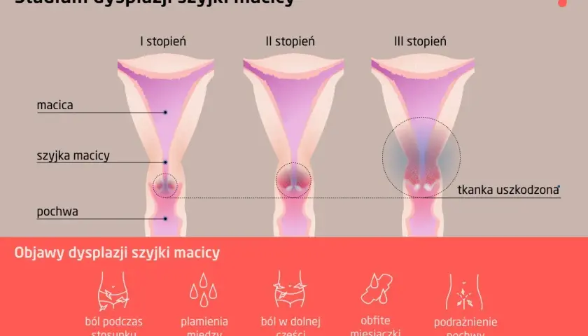 Grafika pokazuje stadia dysplazji szyjki macicy: I, II i III stopień, z zaznaczonymi objawami jak ból, plamienia i podrażnienie.
