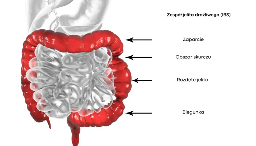 Zespół jelita drażliwego objawy – co powinieneś wiedzieć z forum