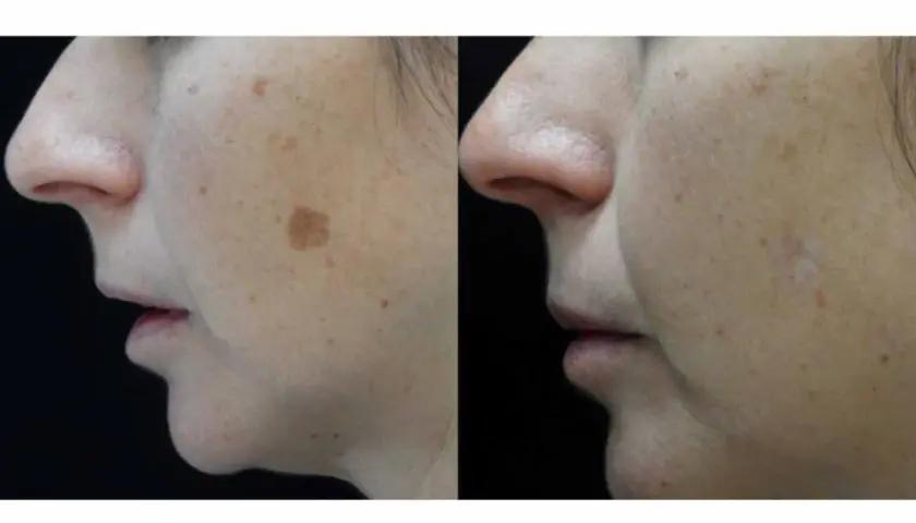 Comparación de piel con manchas solares antes y después de un tratamiento.