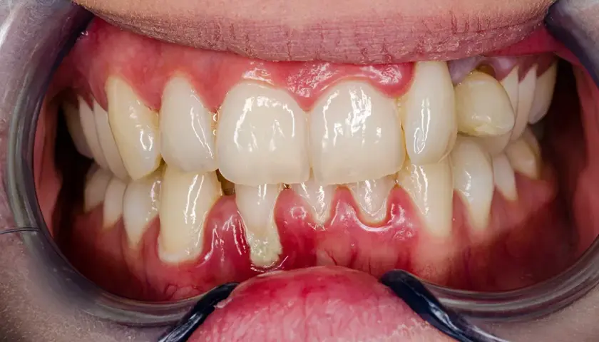 Enfermedad periodontal avanzada con inflamación y sangrado en la encía. Se observa una herida encía con acumulación de placa.