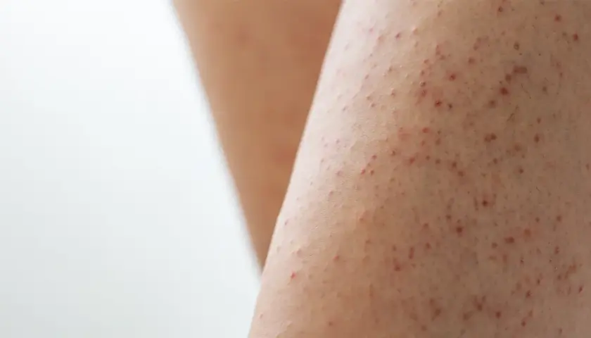 Närbild på ben med keratosis pilaris, små röda prickar som ger en knottrig hudtextur.