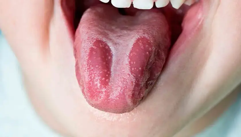 Lengua geográfica con parches blancos y rosados, como un mapa de sabores.