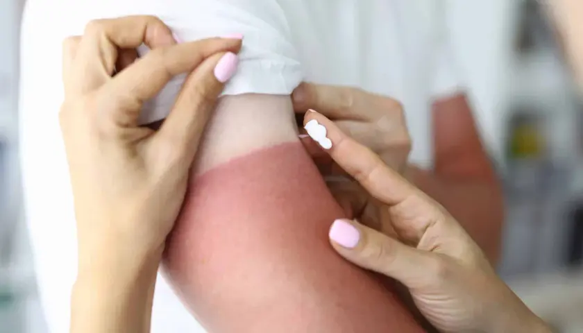 Application de crème pour désinfecter une brûlure solaire sur un bras rouge.